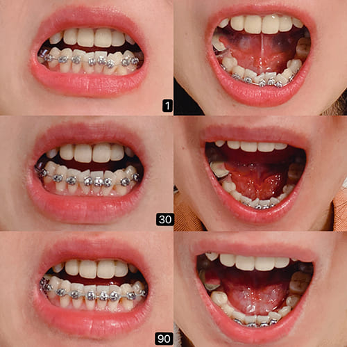 orthodontic process(0).jpg