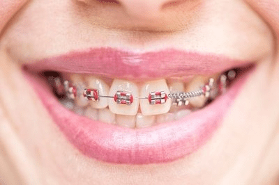 What is orthodontics (2).png